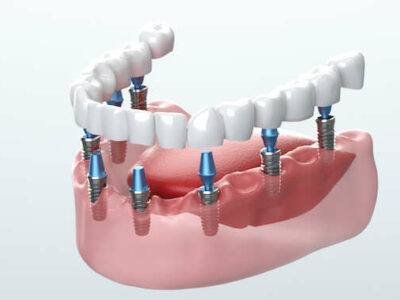 Dental Implants in Colombo