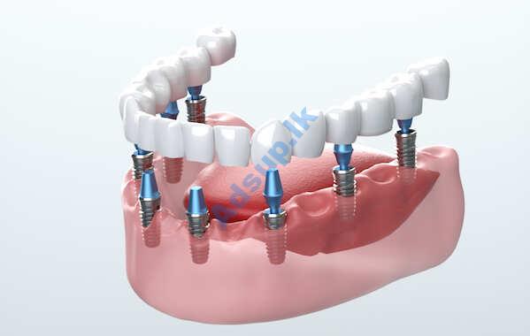 Dental Implants in Colombo